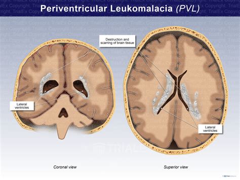 what is periventricular leukomalacia.